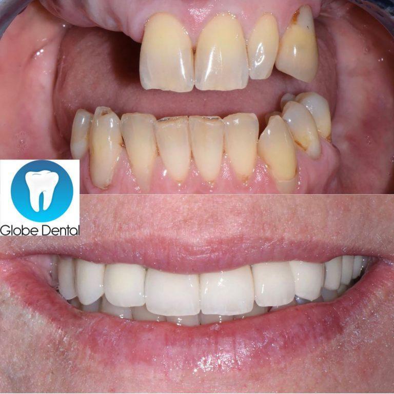 Előtte-utánna-globedental-balatonkenese-budapest.jpeg