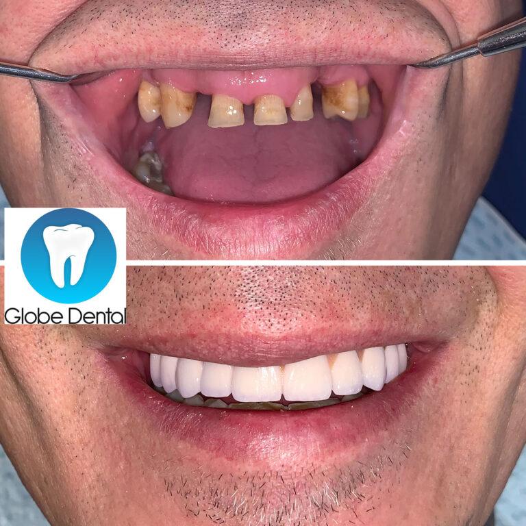 Elotte-utanna-Globedental-balatonkenese-budapest-1-feher.jpg