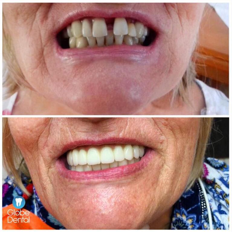 globedental-elotte-utana