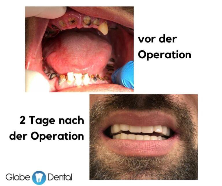 Globe Dental Zahnklinik Vorher Nachher