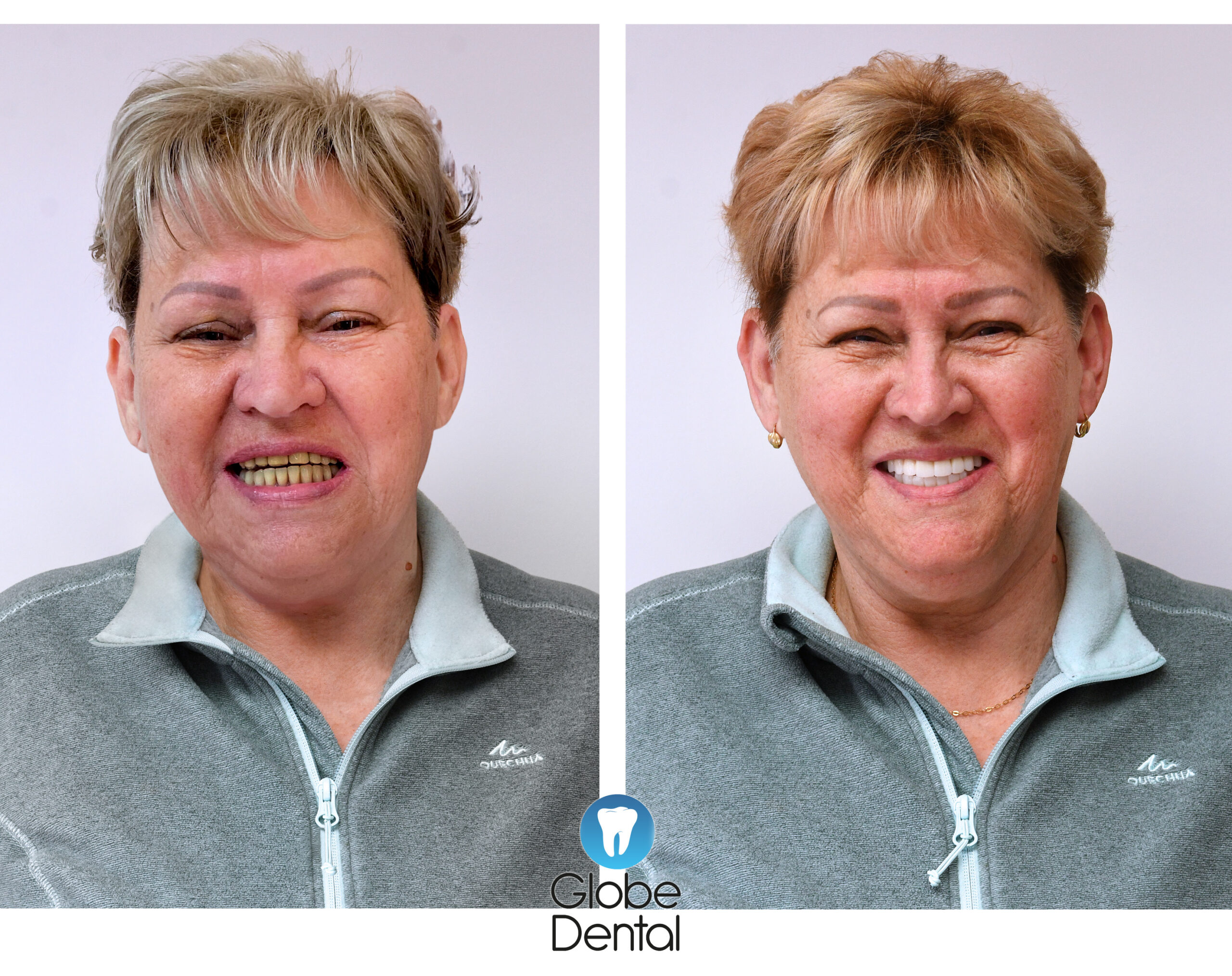 Hérics_Józsefné_előtte_utána