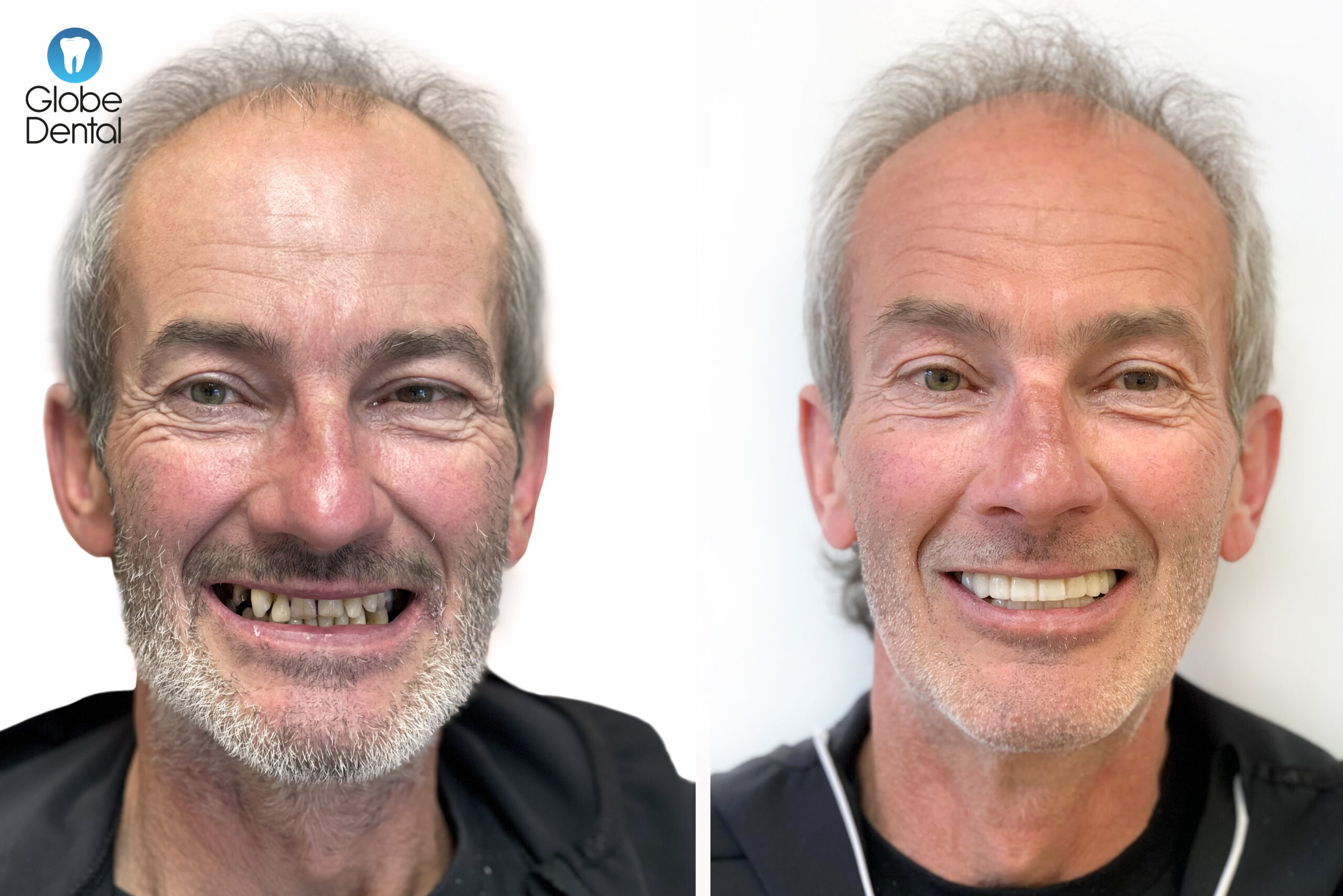 Alex_F_Előtte_Utána_1