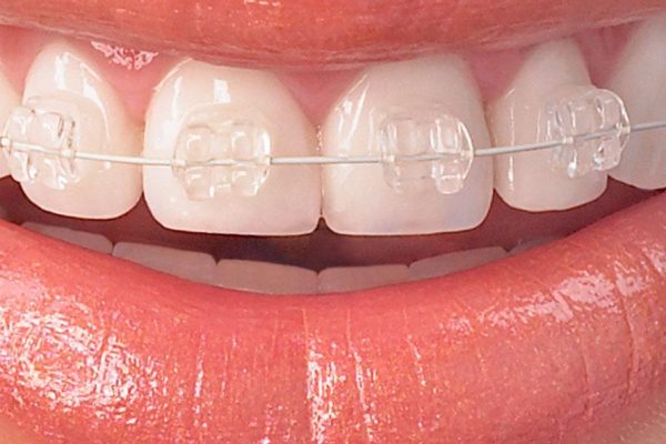Fogszabalyozas-Orthodontics.jpg
