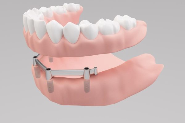 Steges-fogsor-Dental-dentures.jpg